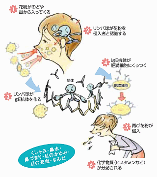 (1)花粉症のメカニズム 花粉→リンパ球→IgE抗体→肥満細胞→ヒスタミン→くしゃみなどの具体的な症状